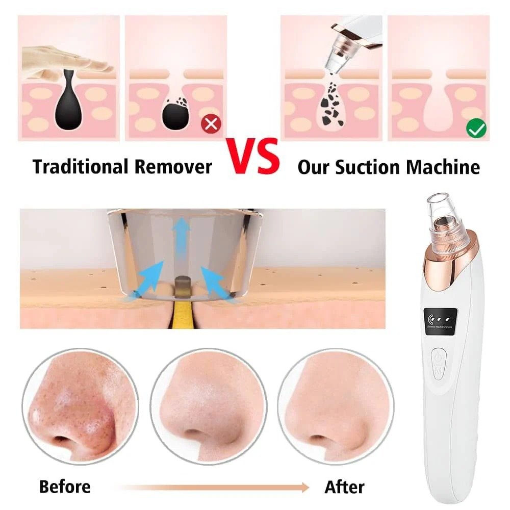 Blackhead Remover - Image 2